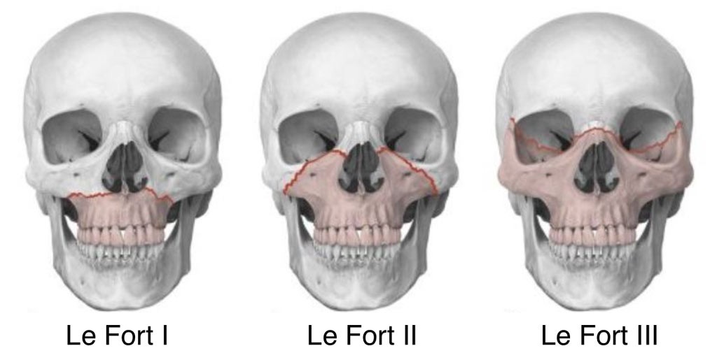 Le Fort Fracture | Definition, Fracture Types, And Symptoms