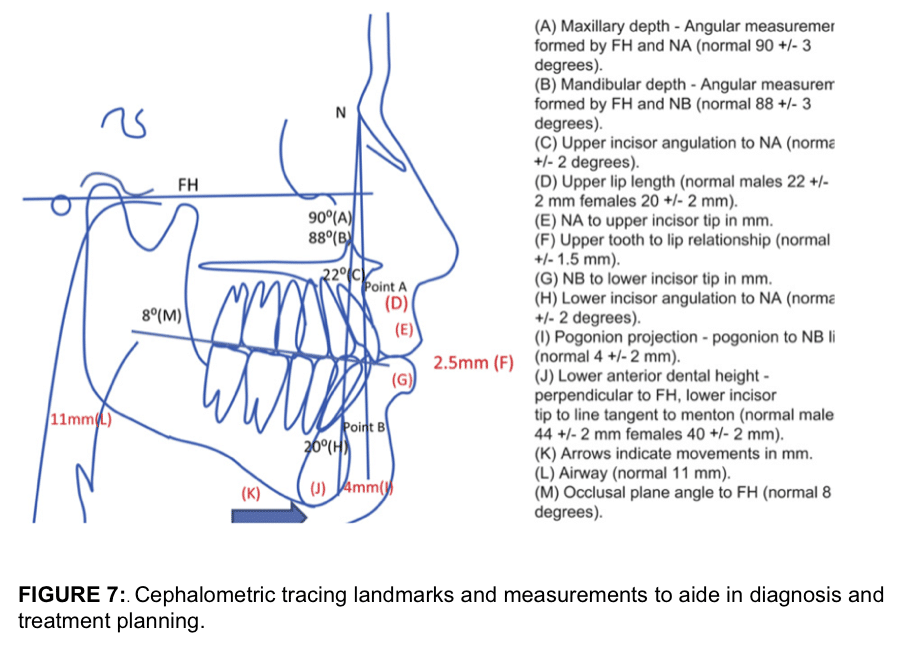 Total Temporomandibular Joint (TMJ) Replacement