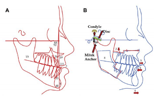 cephalometric analysis shows the class iii skeletal and occlusal cephalometric analysis