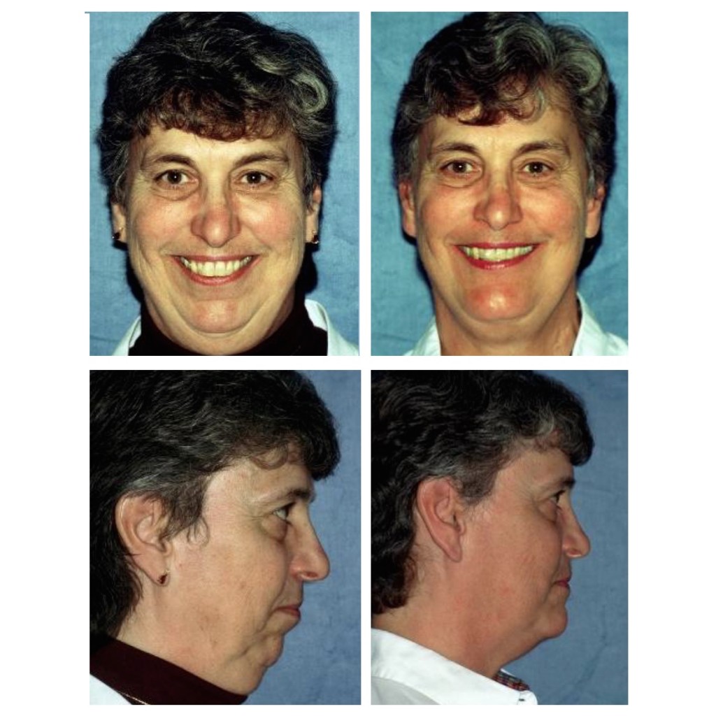 Before and After Photos Maxillofacial Surgery Larry M. Wolford, DMD