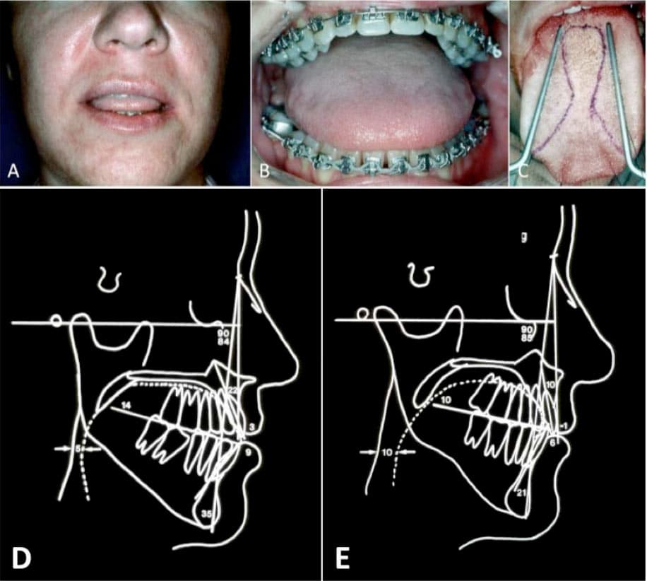 macroglossiawithtongueprotrusion Larry M. Wolford, DMD