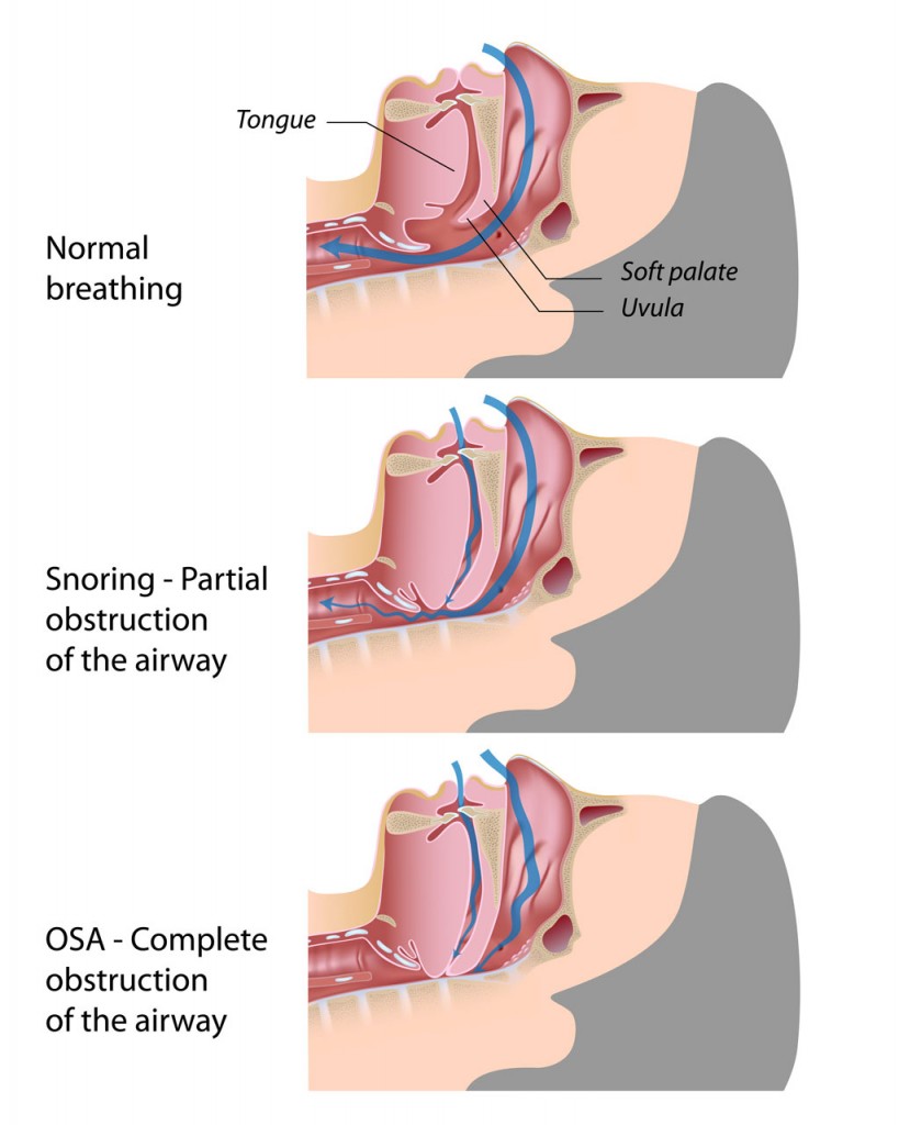 Airway Evaluation for TMJ and Corrective Jaw Surgery