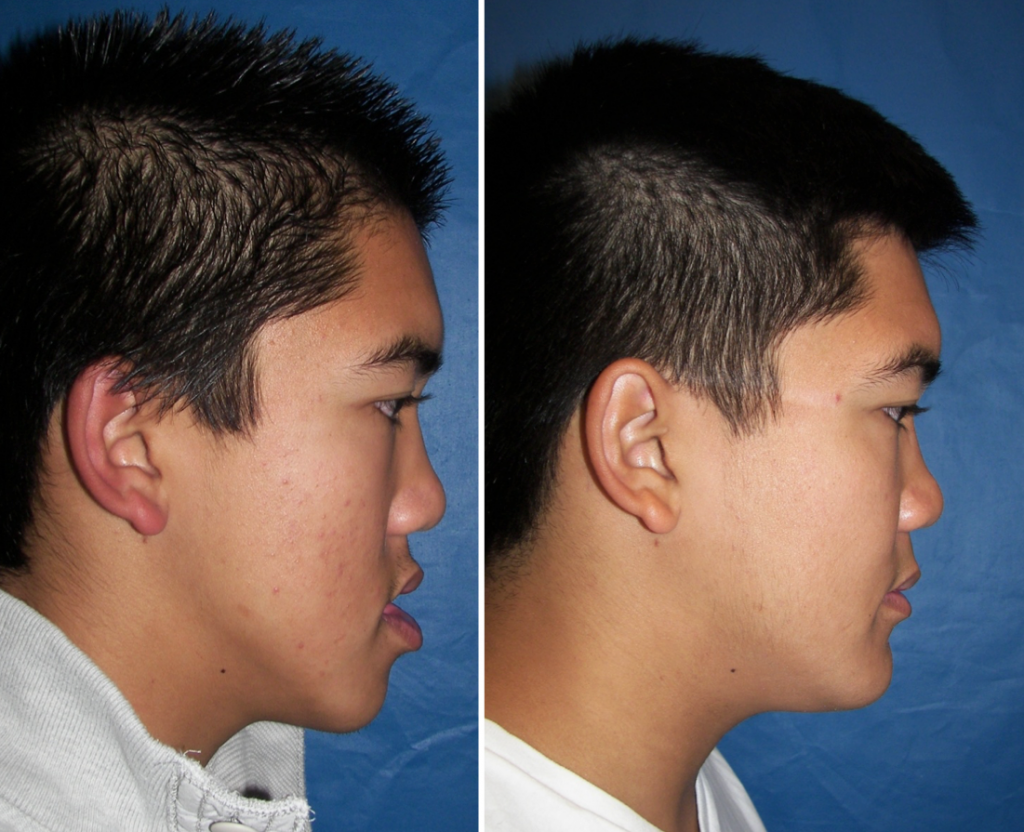 Before & After Case 14b mandible surgery Larry M. Wolford, DMD