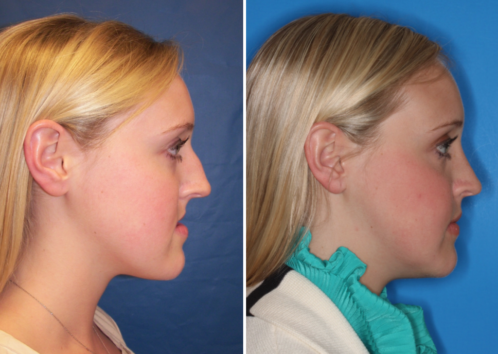 Before & After Case 15b mandible surgery Larry M. Wolford, DMD