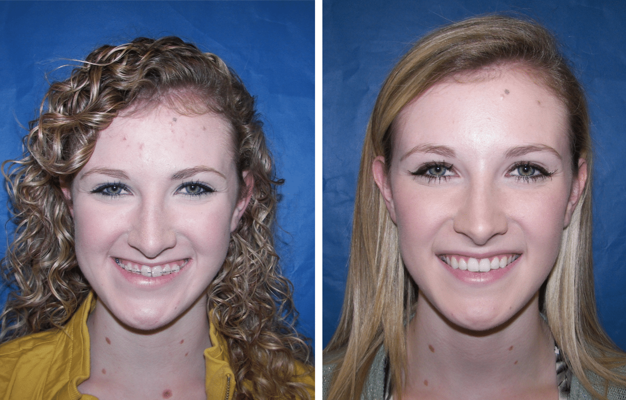 Before & After Case 16 mandible surgery Larry M. Wolford, DMD