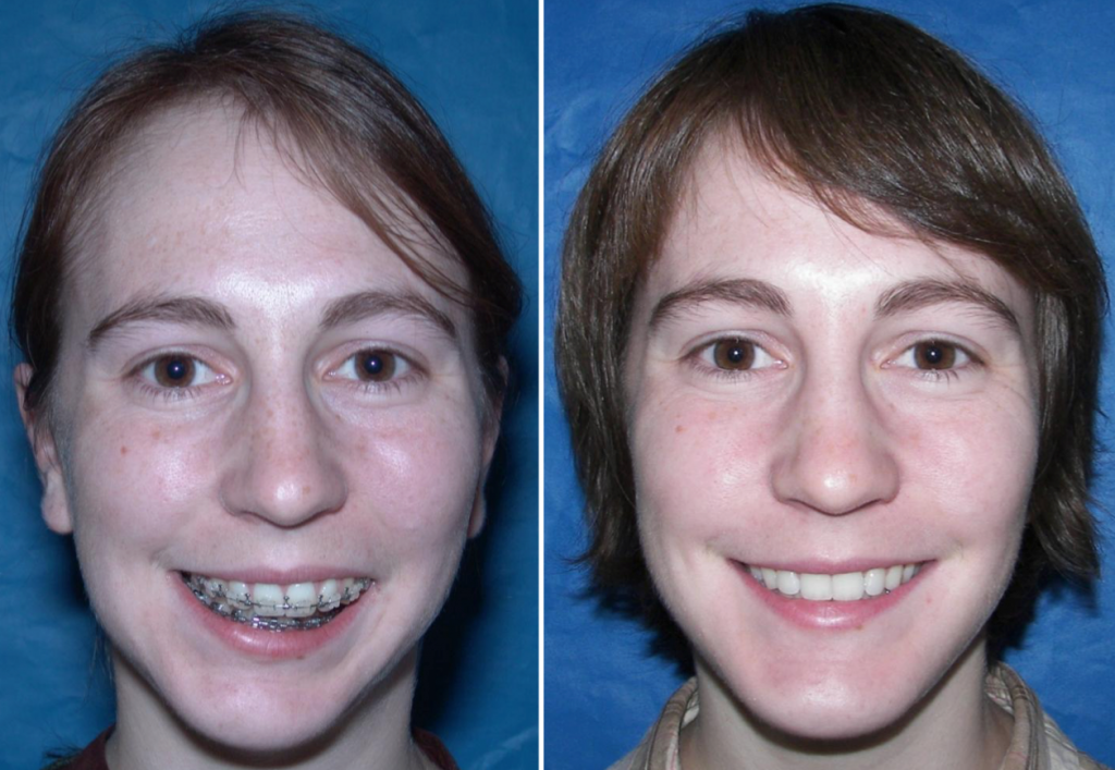 Before & After Case 19 jaw arthritis Larry M. Wolford, DMD