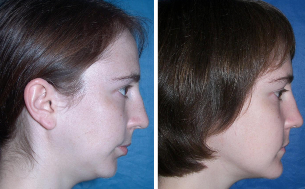 Before & After Case 19b jaw arthritis Larry M. Wolford, DMD