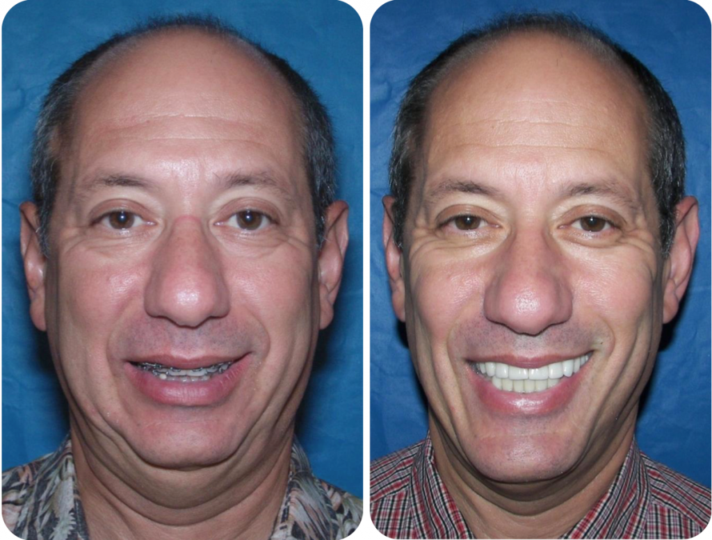 Before & After Case 2 Sleep Apnea Surgery