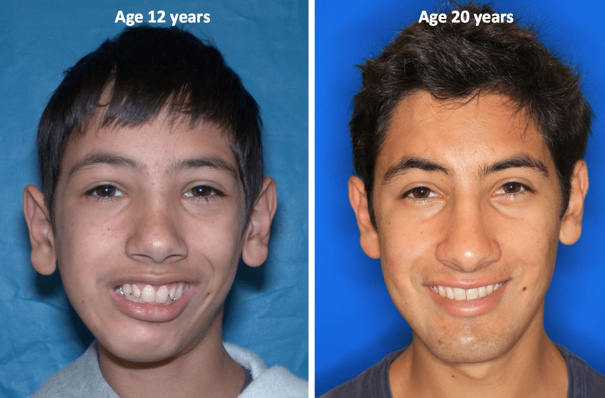 Before & After Case 21 TMJ surgery ankylosis - Larry M. Wolford, DMD