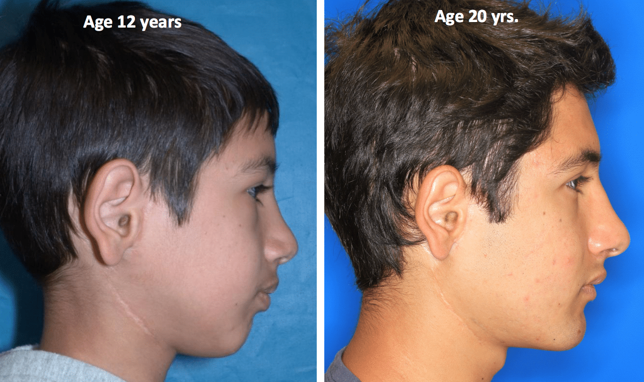 Before & After Case 21b TMJ surgery ankylosis - Larry M. Wolford, DMD