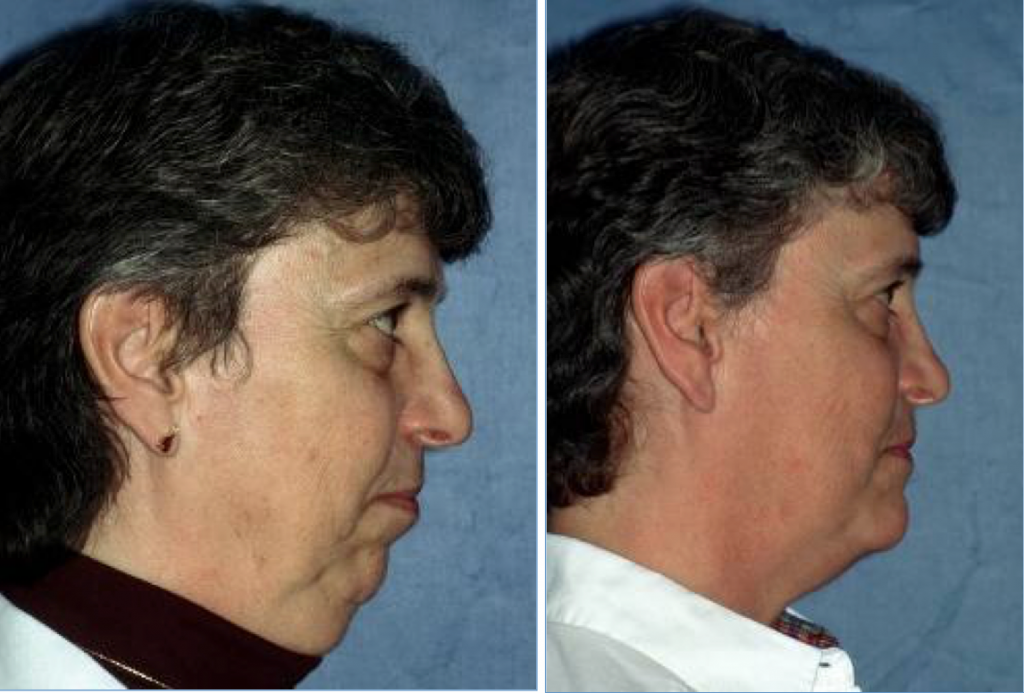 Before & After Case 3b Sleep Apnea Surgery