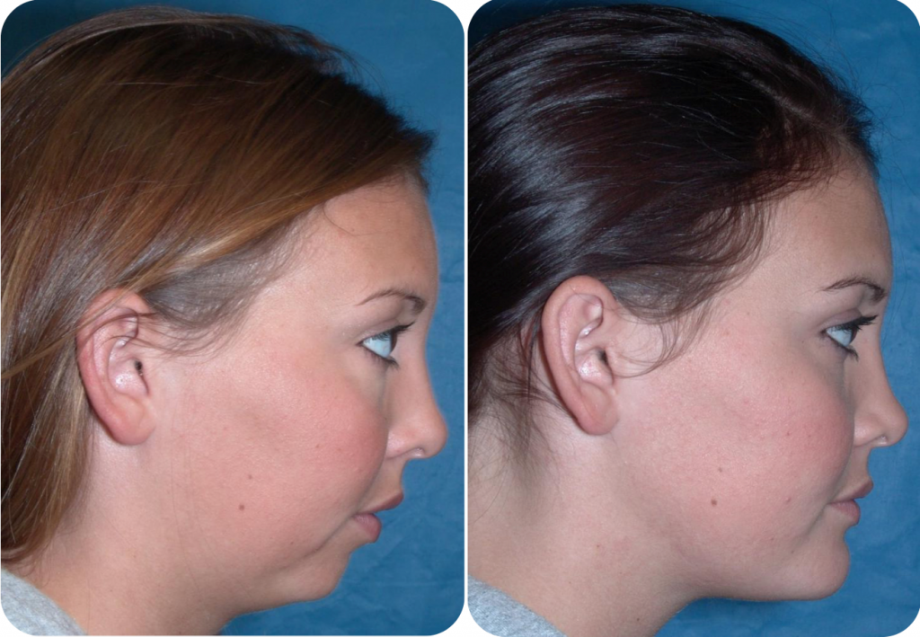 Before & After Case 4b Sleep Apnea Surgery