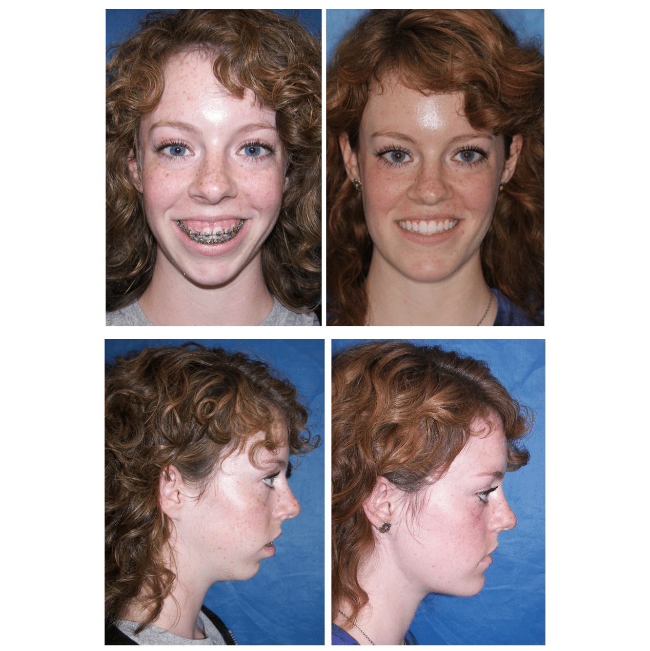 Before and After Photos Maxillofacial Surgery Larry M. Wolford, DMD